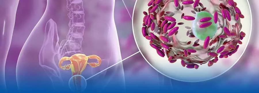 Asociación entre disbiosis vaginal y diabetes gestacional con resultados perinatales adversos