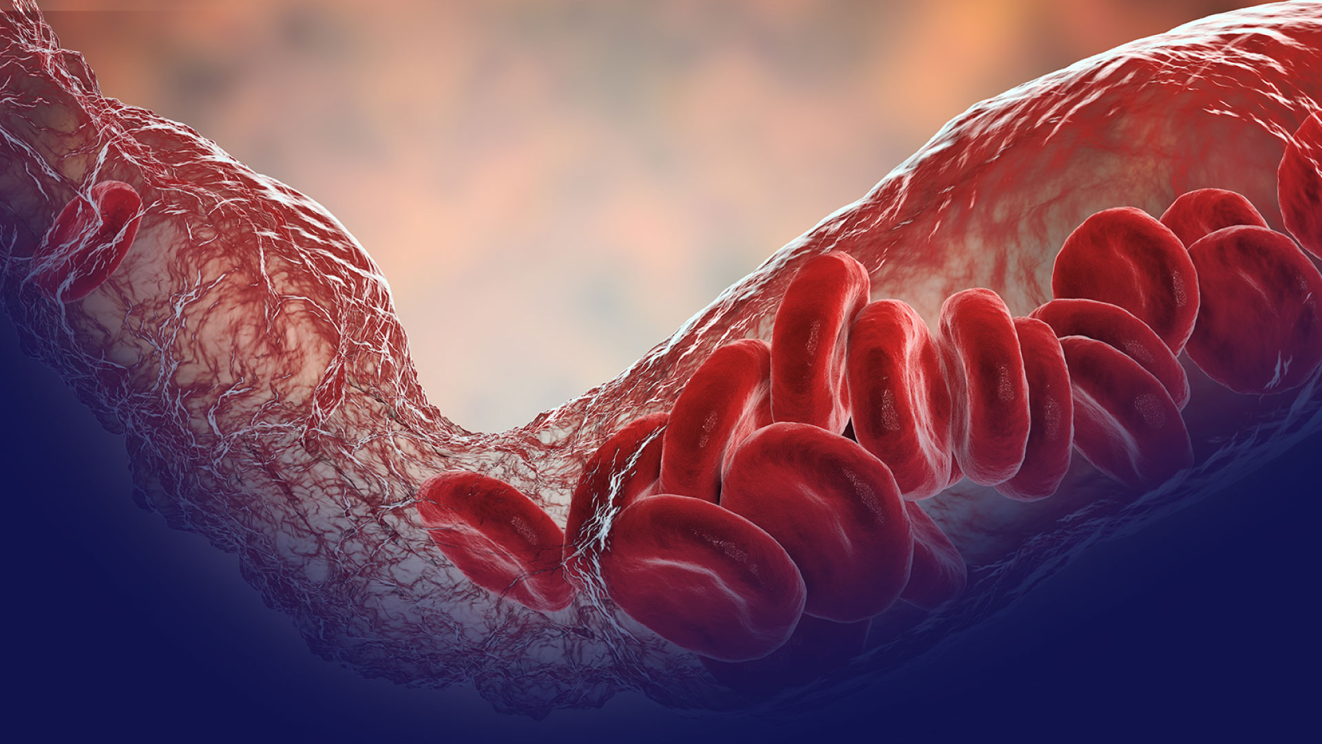 Riesgo Tromboembólico y Anticoncepción: manejo basado en la evidencia - Parte 2